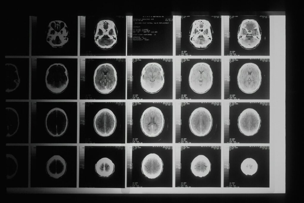 A series of brain scan images on a light board