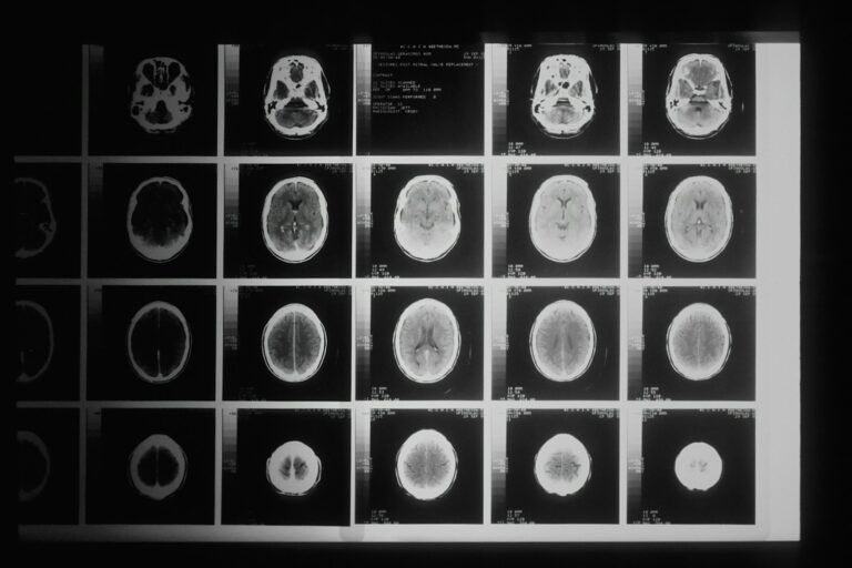 Concussion after an accident: why “mild” brain injuries are not minor, and how to protect your claim