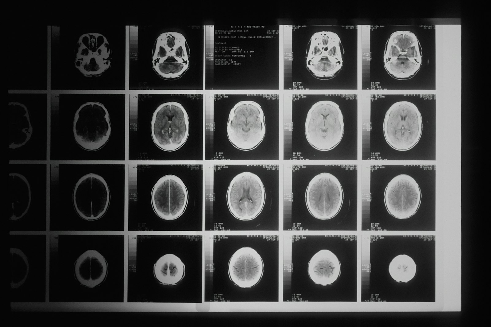 A series of brain scan images on a light board